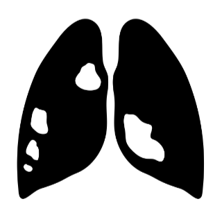 Lungenkrebs Früherkennung